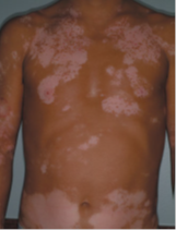 :مريض مع مناطق معممة من نقص الصباغ